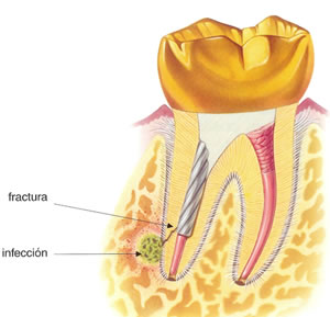 complicaciones endodoncia especialistas madrid